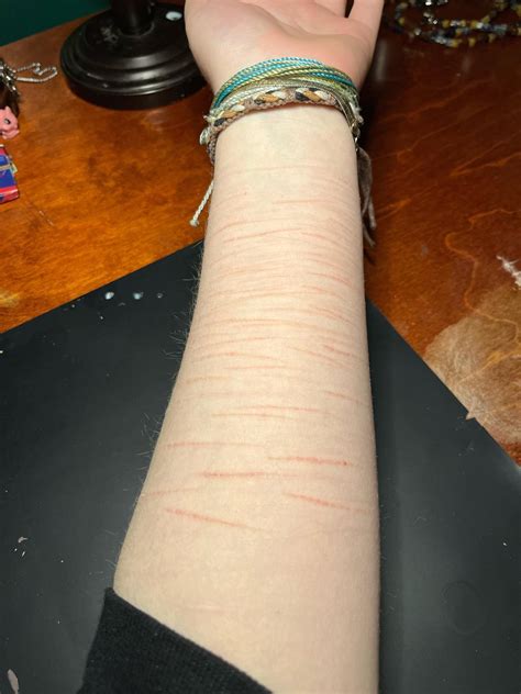 Im noticing scars on a girl I follow on Onlyfans : r/selfharm